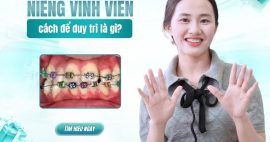niềng răng có được vĩnh viễn không