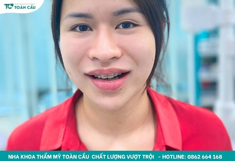 Đeo hàm duy trì trong 6-12 tháng