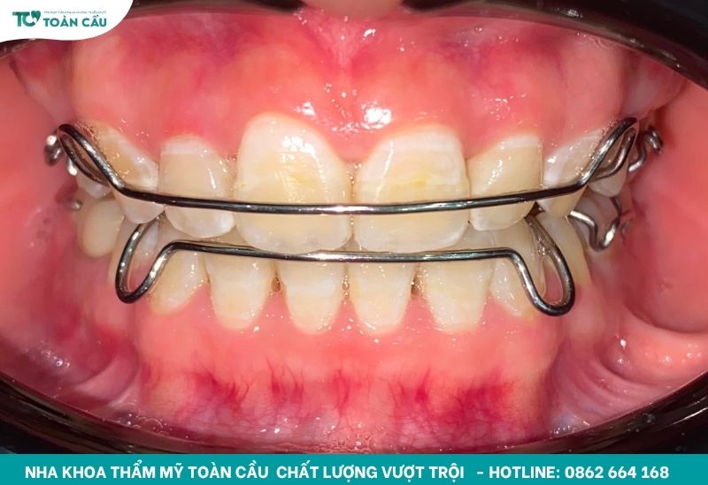 Đeo hàm duy trì đúng thời gian