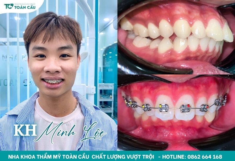 Khách hàng niềng răng tại Toàn Cầu