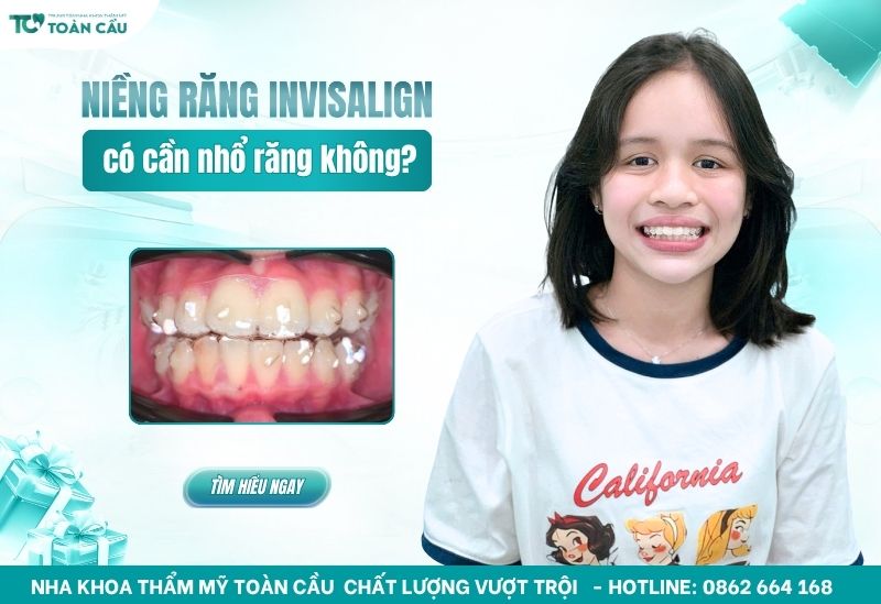 Niềng răng Invisalign có cần nhổ răng