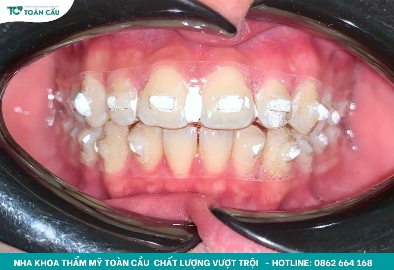 Niềng răng Invisalign