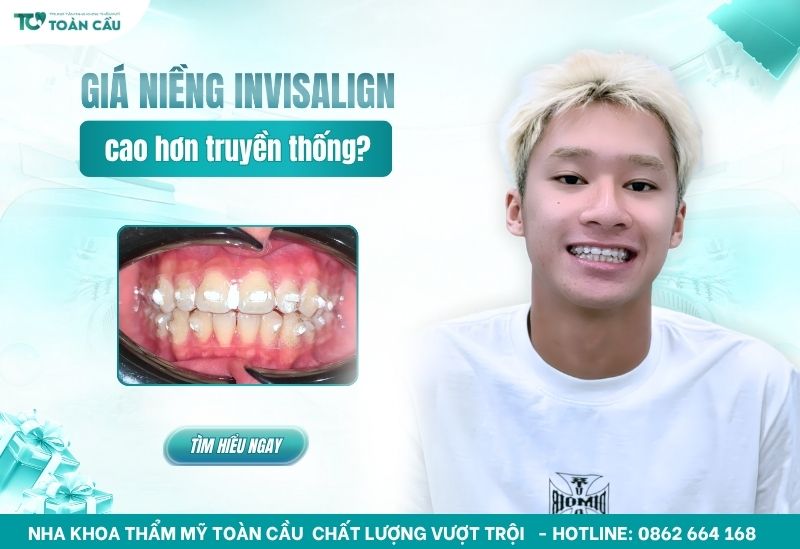 Niềng răng Invisalign giá