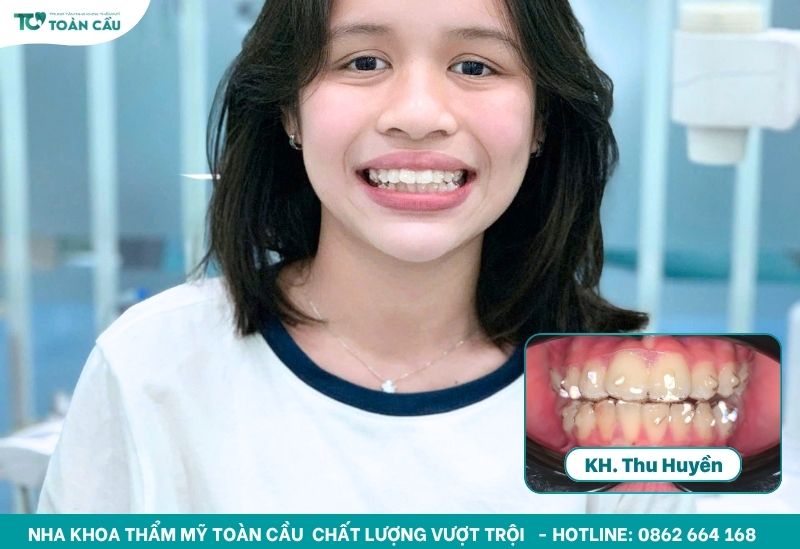 Khay niềng gần như vô hình