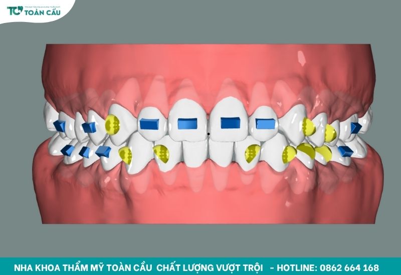 Mô phỏng chính xác từng bước di chuyển của răng
