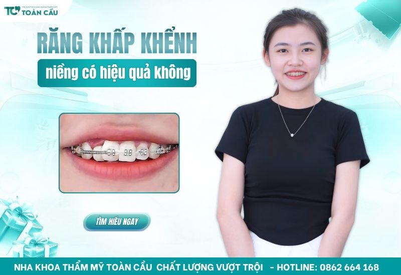 niềng răng khấp khểnh nặng