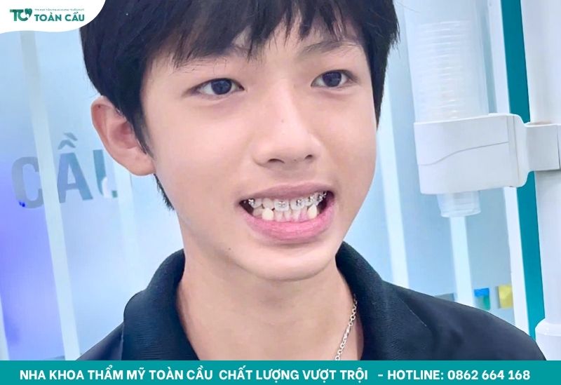Niềng răng khấp khểnh nặng