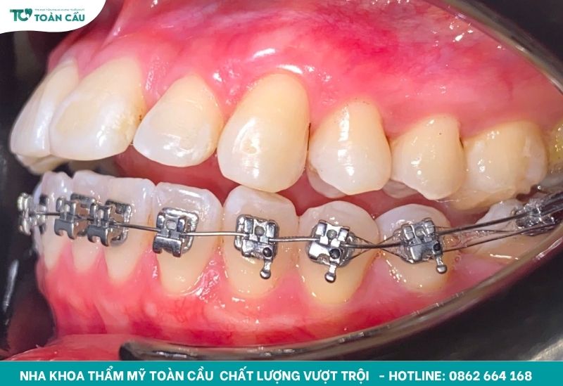 Niềng răng khấp khểnh tại Toàn Cầu