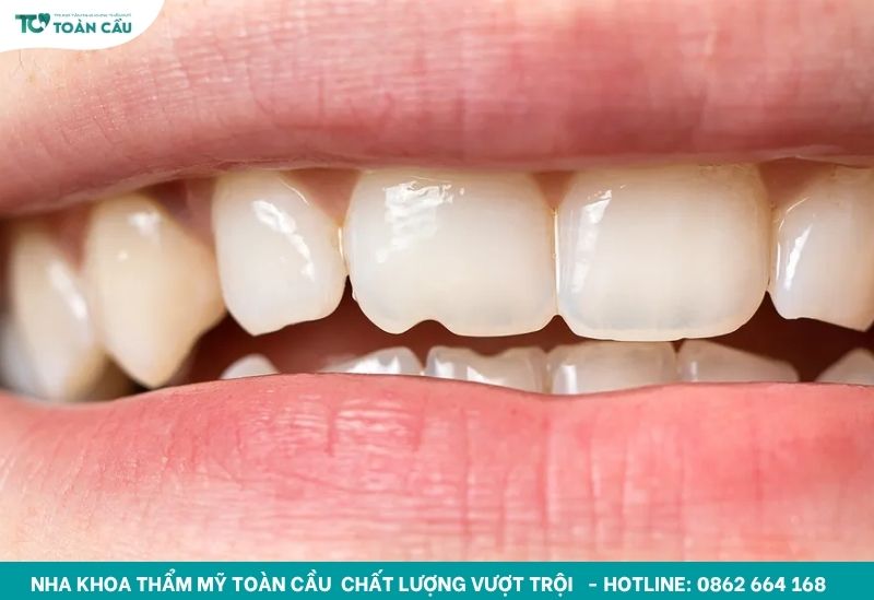 Răng bị mẻ gây mất thẩm mỹ