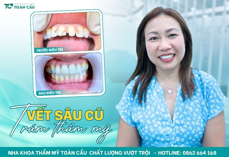 Nguyên nhân khiến răng cửa bị sâu bên trong và cách điều trị 4 Hàn trám răng bằng vật liệu thẩm mỹ