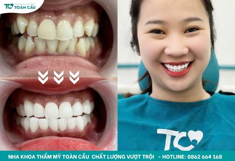 Nguyên nhân khiến răng cửa bị sâu bên trong và cách điều trị 5 Bọc răng sứ thẩm mỹ