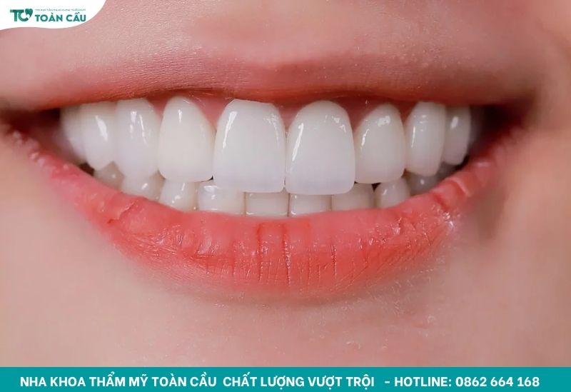 Ảnh hưởng của răng cửa bị sâu đen đến nụ cười