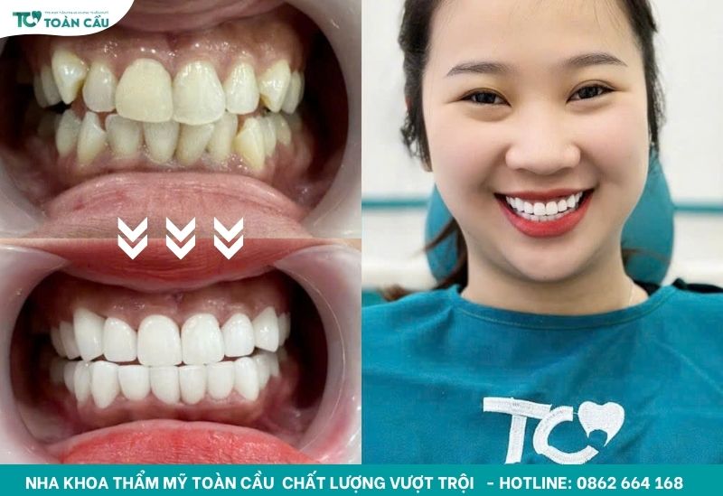 Khách hàng chọn bọc răng sứ răng cửa 