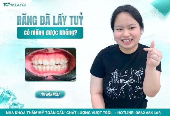 răng đã lấy tủy có niềng được không