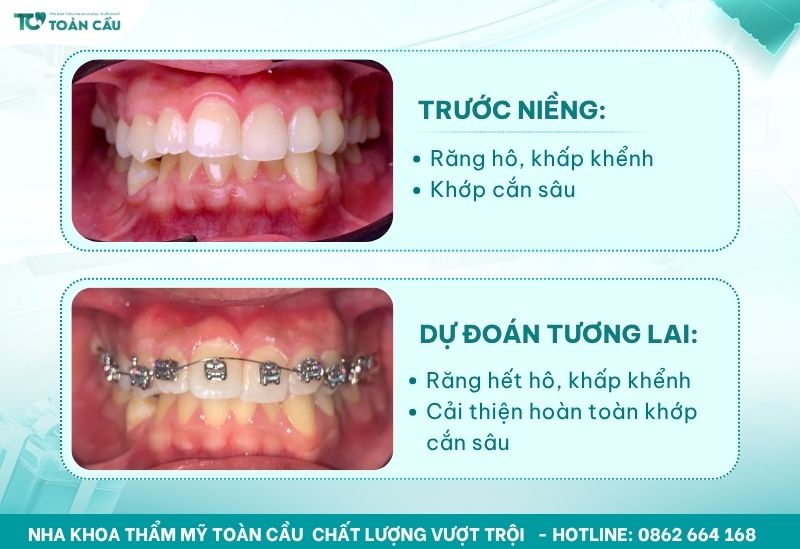 Răng đã lấy tủy có niềng được không và có ảnh hưởng gì không? 6 Niềng răng toàn diện và chuyên nghiệp