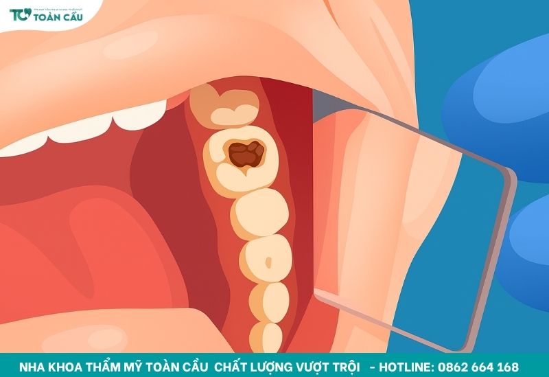 Răng số 7 bị sâu vỡ