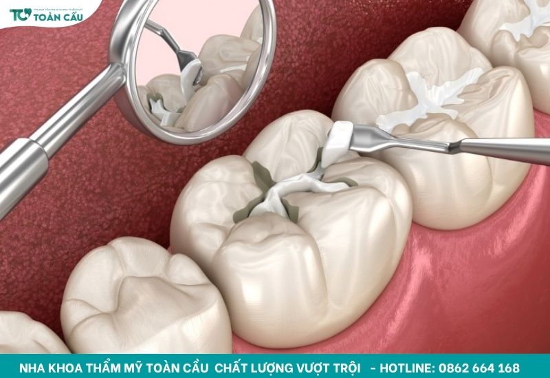 Trám răng composite là gì?