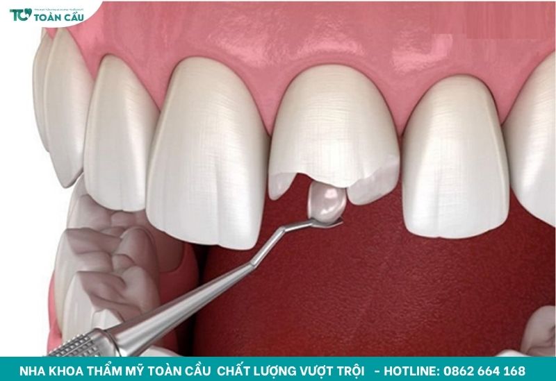 Trám thẩm mỹ răng cửa Composite