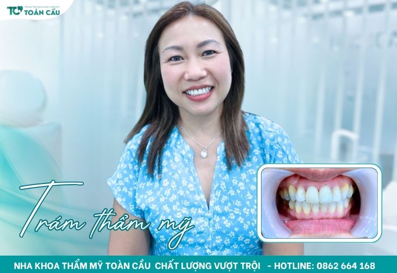 Trám răng thẩm mỹ Nha khoa Toàn Cầu