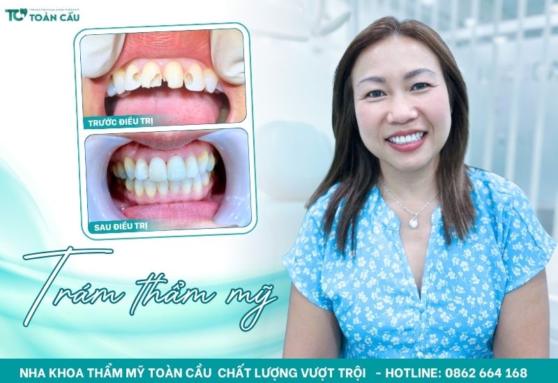 Trám răng sâu tại Nha khoa Toàn Cầu