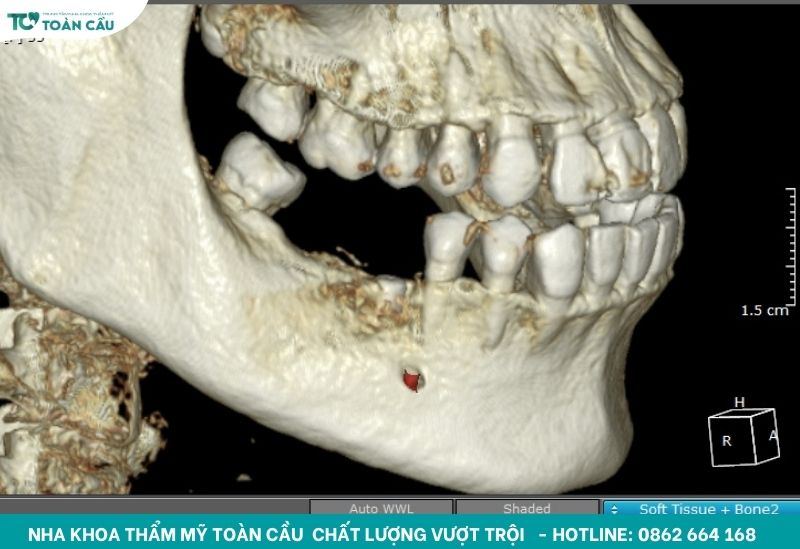 Ngăn chặn quá trình tiêu xương hàm