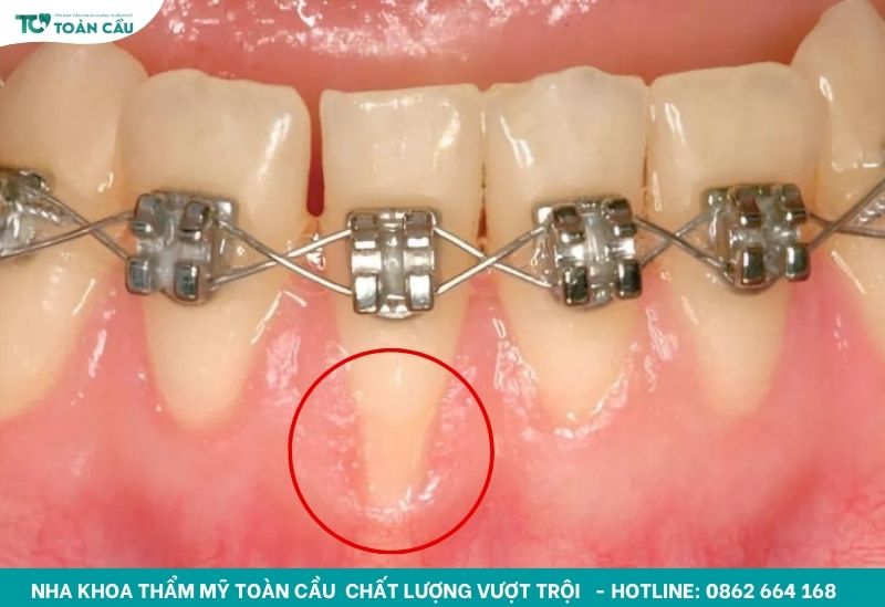 5 dấu hiệu tiêu xương răng khi niềng