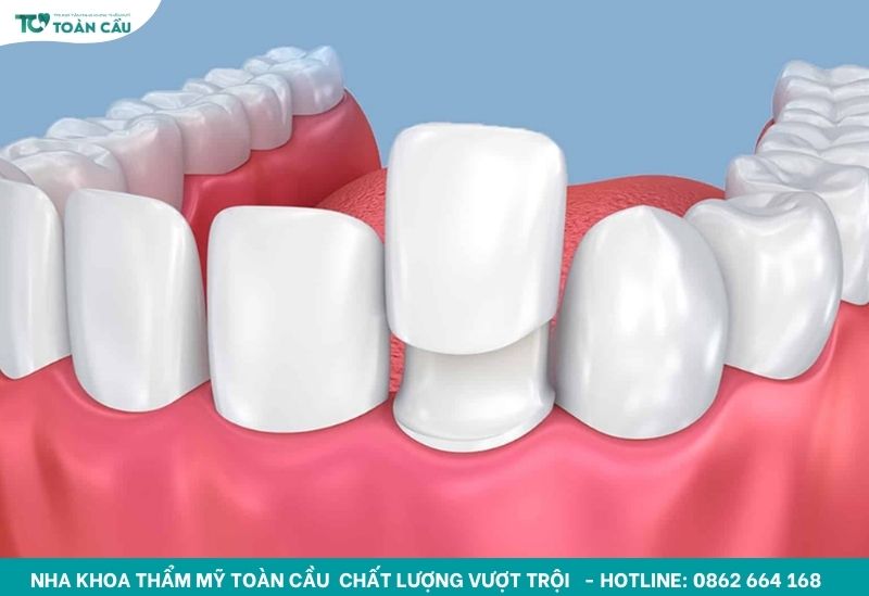 Gắn răng tạm sau khi mài răng