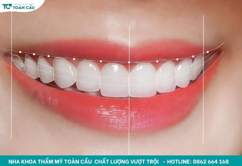 Đường cung răng cân xứng hoàn hảo