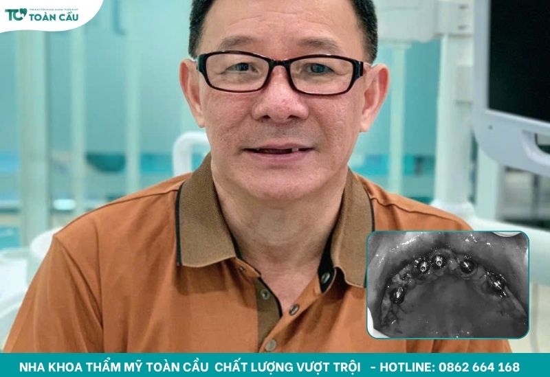 Cấy implant All-on-5