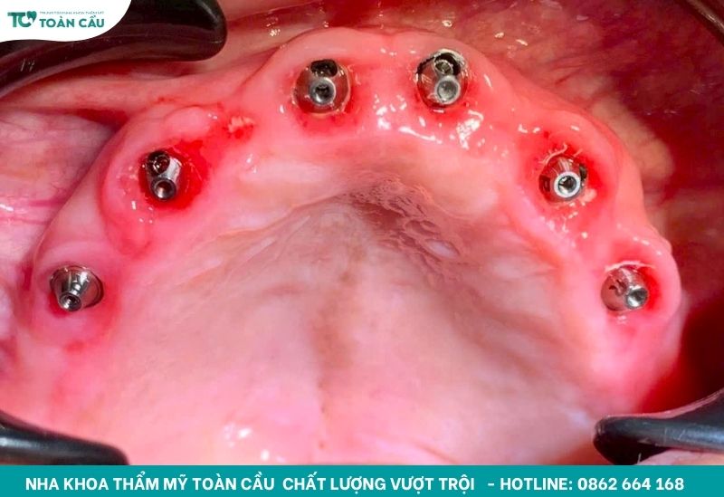 Trồng implant trong 7 ngày cho Việt Kiều về nước ngắn ngày 2 Vì sao nên trồng implant trong 7 ngày?