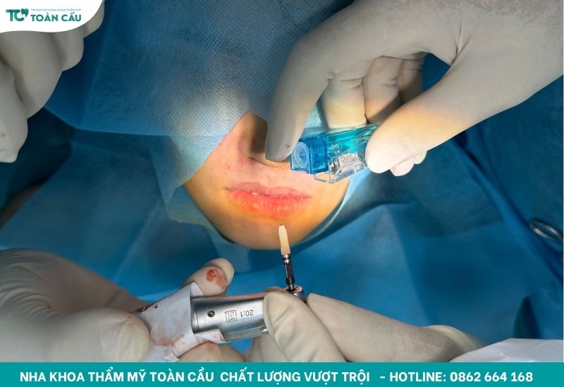 Trồng implant trong 7 ngày cho Việt Kiều về nước ngắn ngày 3 Cấy ghép implant tức thì