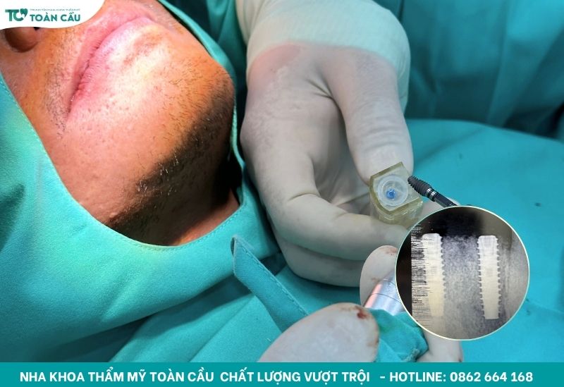Làm implant ở Việt Nam có an toàn không? Góc nhìn của Việt Kiều 4 Cấy ghép implant tức thì