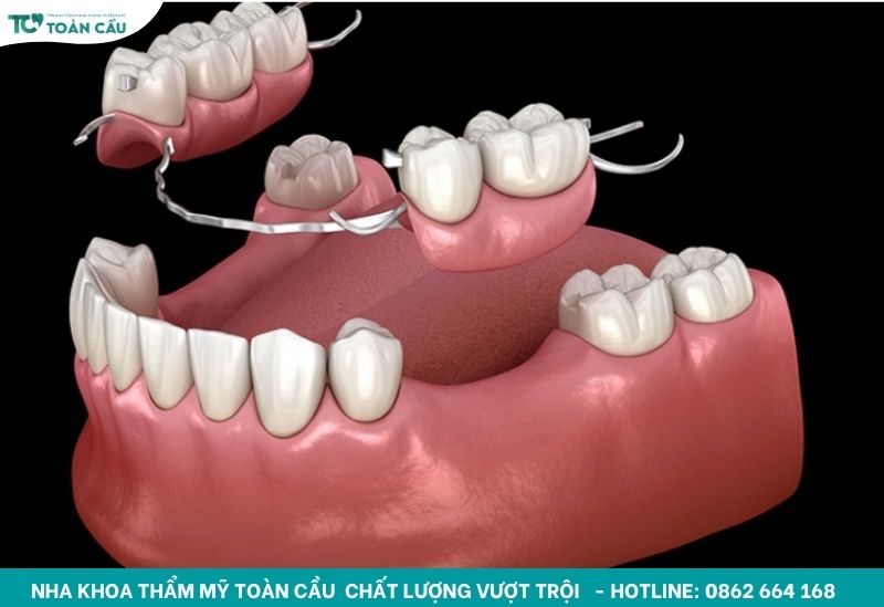 Hàm răng giả tháo lắp cho người lớn tuổi