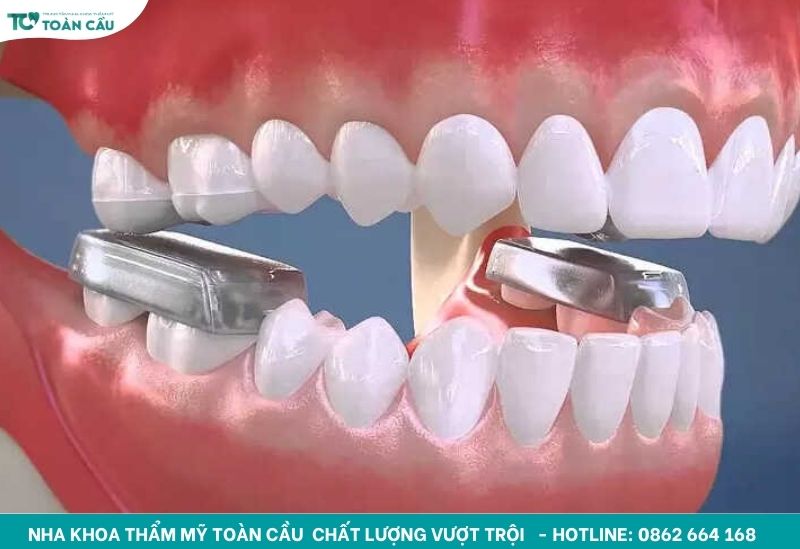 Nâng khớp cắn khi niềng răng để làm gì?