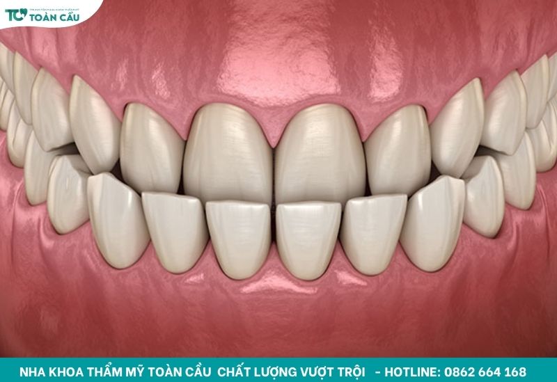 Khớp cắn ngược