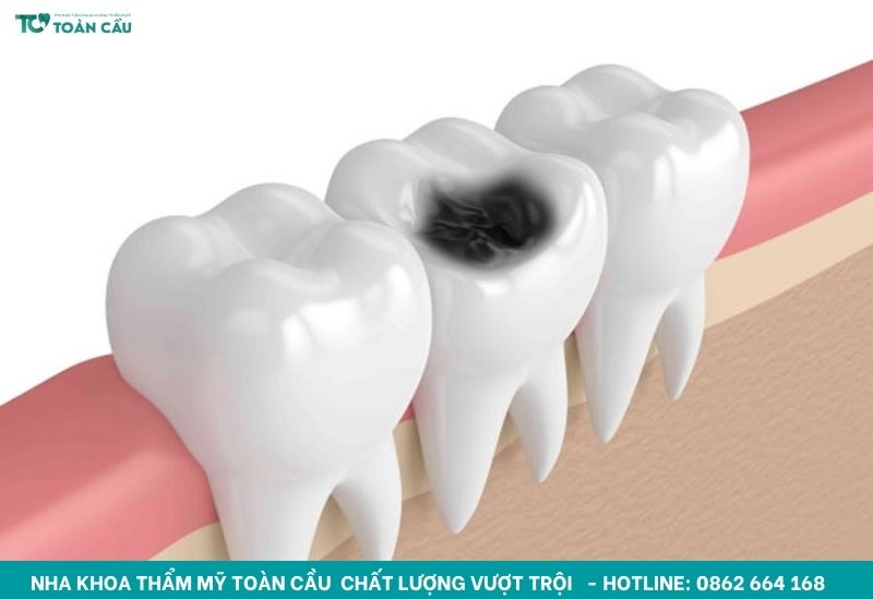 Sâu răng và viêm tuỷ