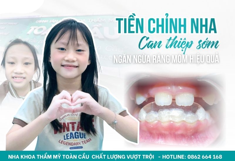 Niềng răng sớm cho trẻ tại Nha khoa Toàn Cầu