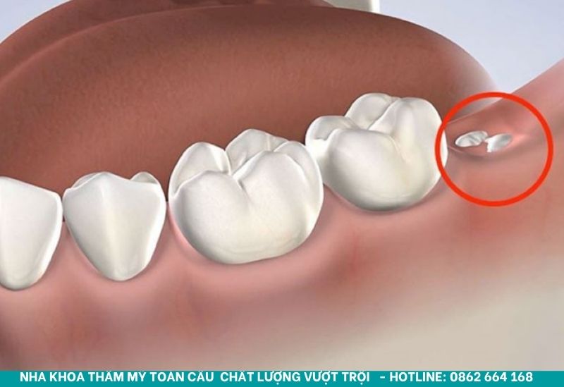 Răng bị gãy còn chân răng