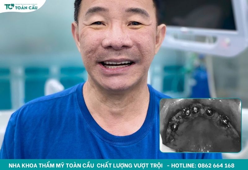 Cấy implant cho các trường hợp gãy răng nặng hơn