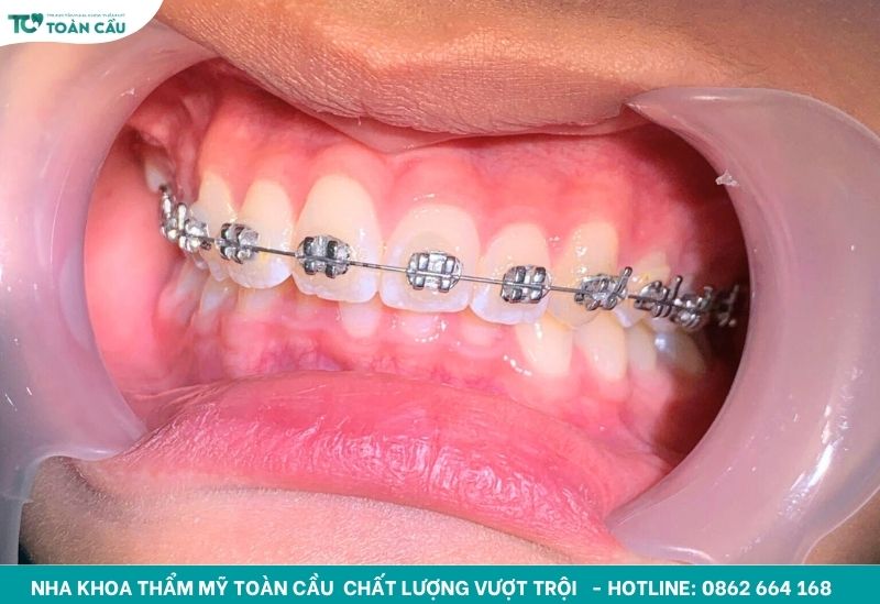 Thời gian niềng răng nhanh nhất là bao lâu?