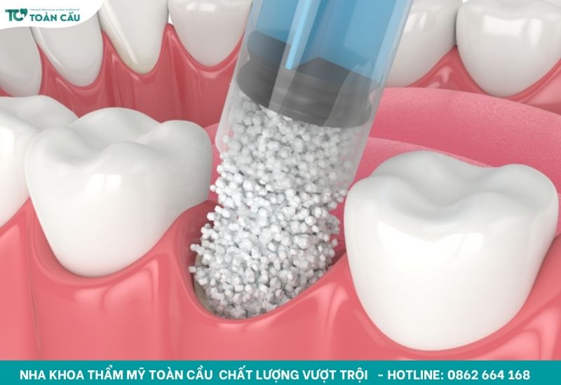 Kỹ thuật ghép xương răng