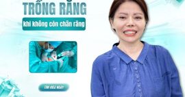 Giải pháp trồng răng khi không còn chân răng bằng implant