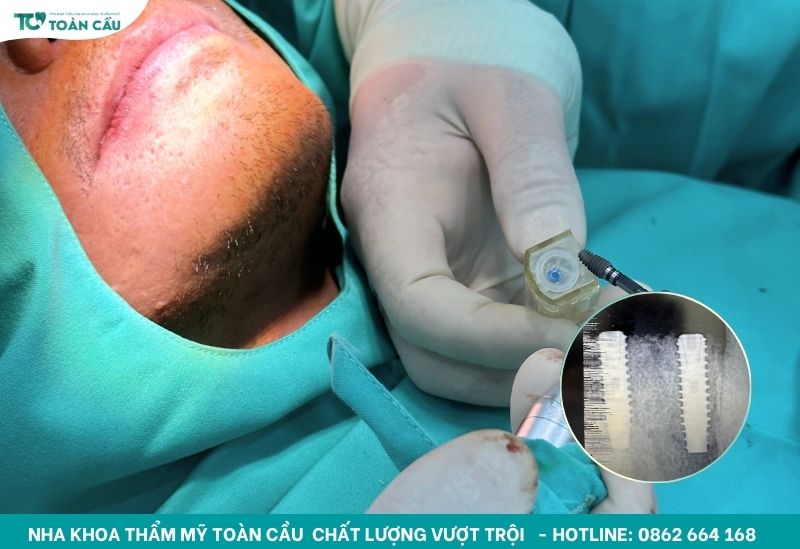 Trồng răng khi không còn chân răng bằng implant