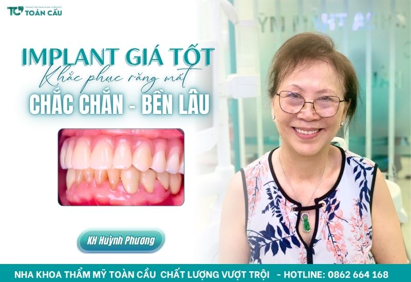 Cấy implant giá tốt tại Toàn Cầu