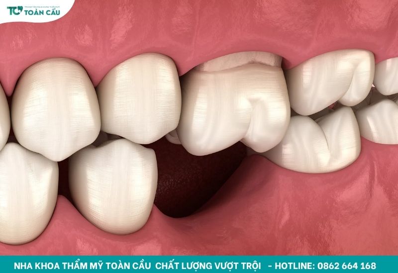 Vì sao Việt Kiều thường trì hoãn điều trị dù mất răng lâu năm? 3 Mất răng lâu ngày sẽ dẫn đến tình trạng tiêu xương ổ răng