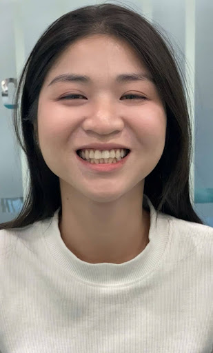 dan su veneer co bi bong khong nguyen nhan cach phong tranh 1