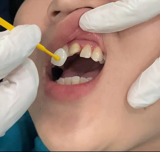 dan su veneer co bi bong khong nguyen nhan cach phong tranh 2