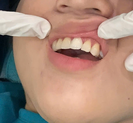 dan su veneer co bi bong khong nguyen nhan cach phong tranh 3