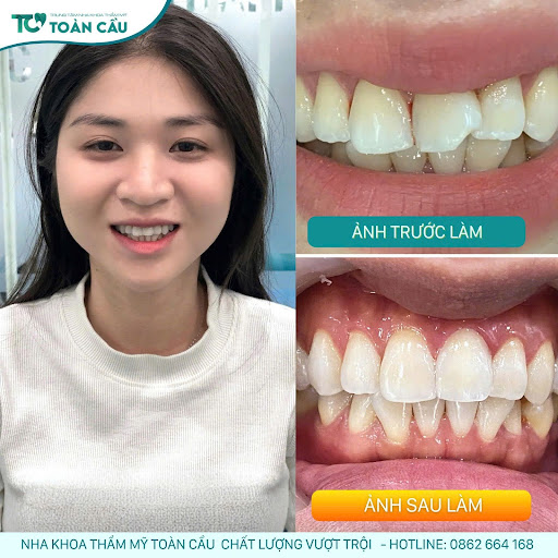 dan su veneer co bi bong khong nguyen nhan cach phong tranh 4