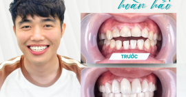 Quy trình bọc răng sứ chuẩn y khoa tại Nha Khoa Toàn Cầu